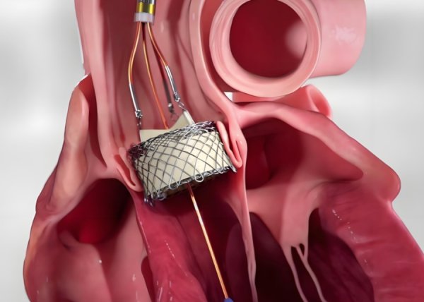 联丰优配 老人吞咽困难竟然查出心脏疾病合并恶性肿瘤，华山胸心外科破困局